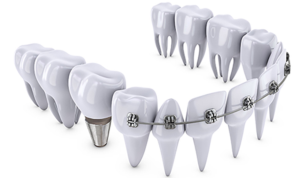ارتودنسی و ایمپلنت دندان