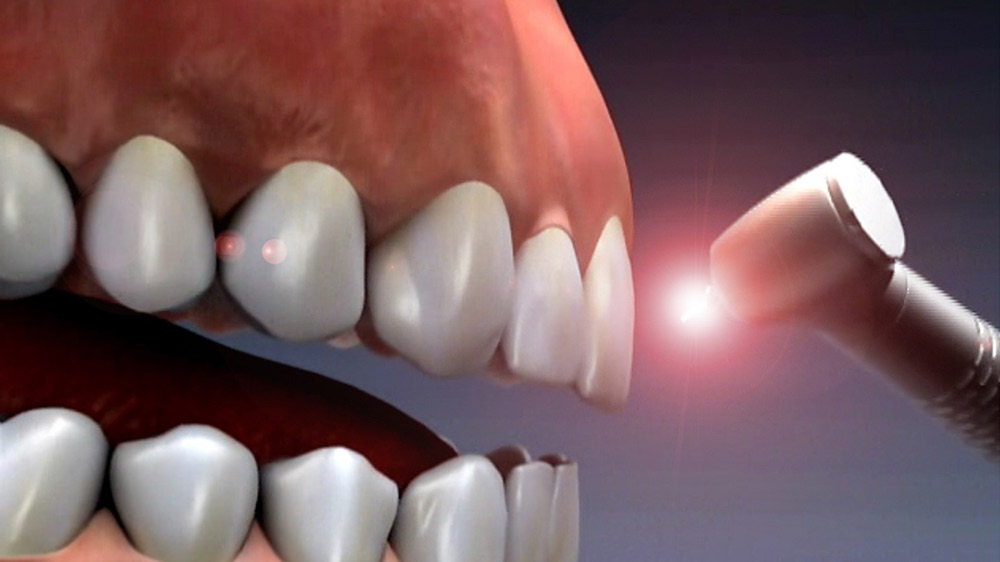 laser orthodontics
