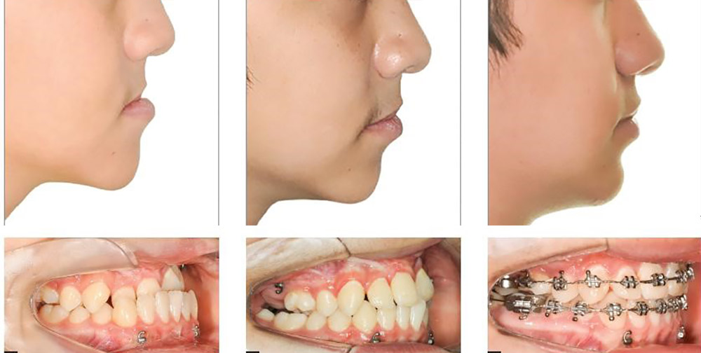 Photo before and after orthodontic treatment of a patient with a genetic disorder