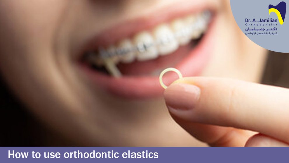 How to use orthodontic elastics Dr Jamilian