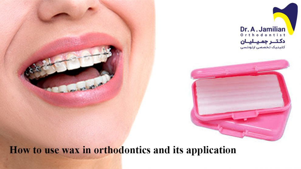 How to use wax in orthodontics and its application Dr Jamilian