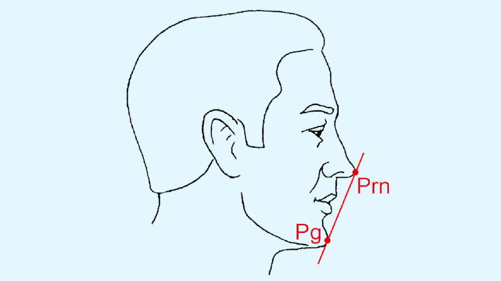 Normal position of lips in relation to the E-line