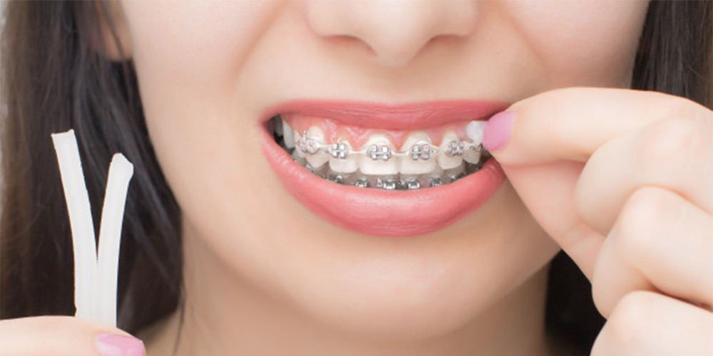 A woman who is using orthodontic wax on a fixed orthodontic bracket