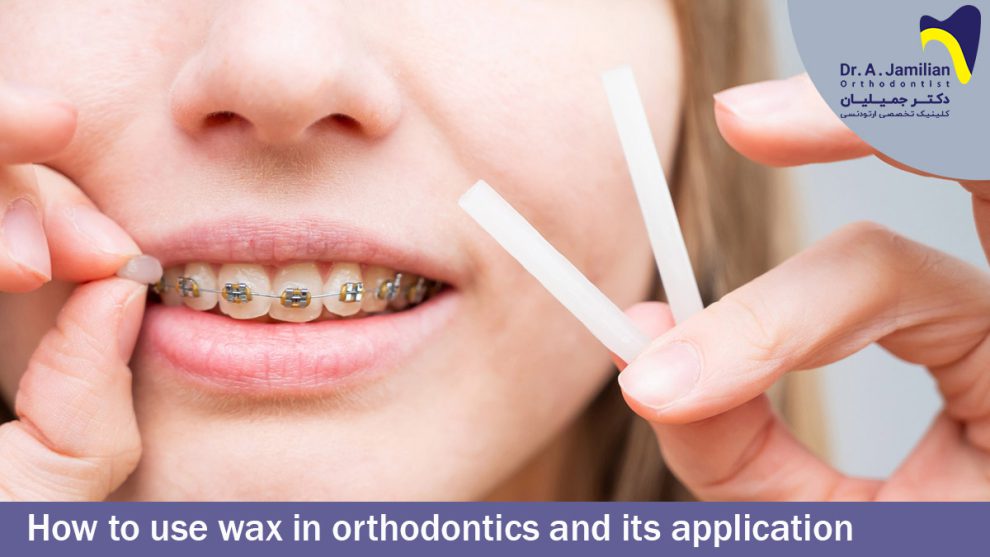 How to use wax in orthodontics and its application Dr Jamilian