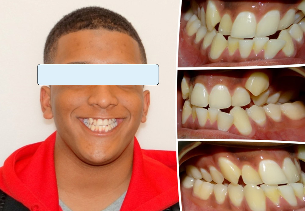 a boy with dental crossbite