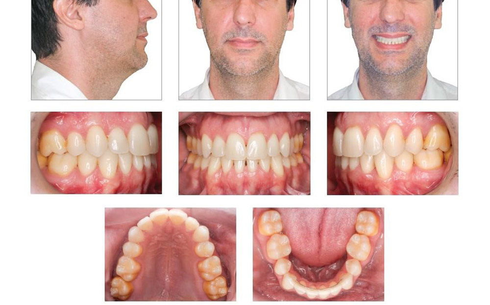 a man who has undergone orthodontic crossbite treatment