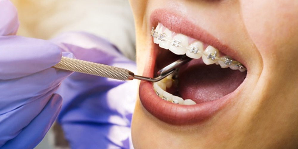 حرکت دندان ها در طول درمان ارتودنسی