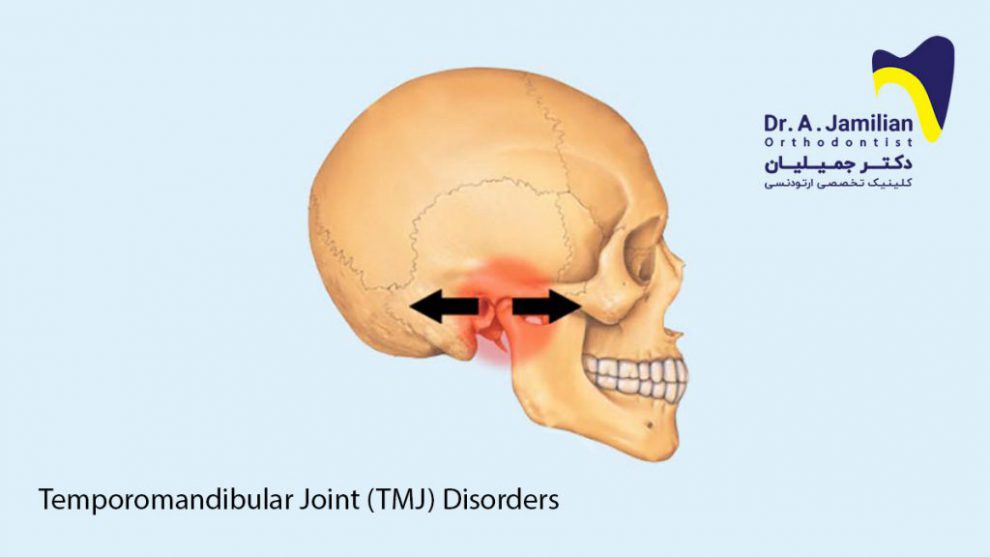 Temporomandibular joint (TMJ) disorders - Dr Jamilian