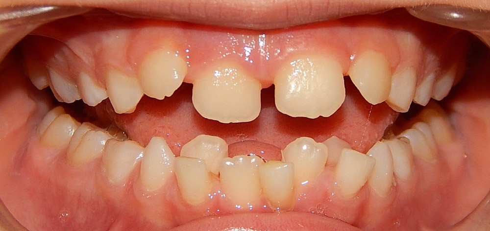 two rows of teeth with a crossbite malocclusion