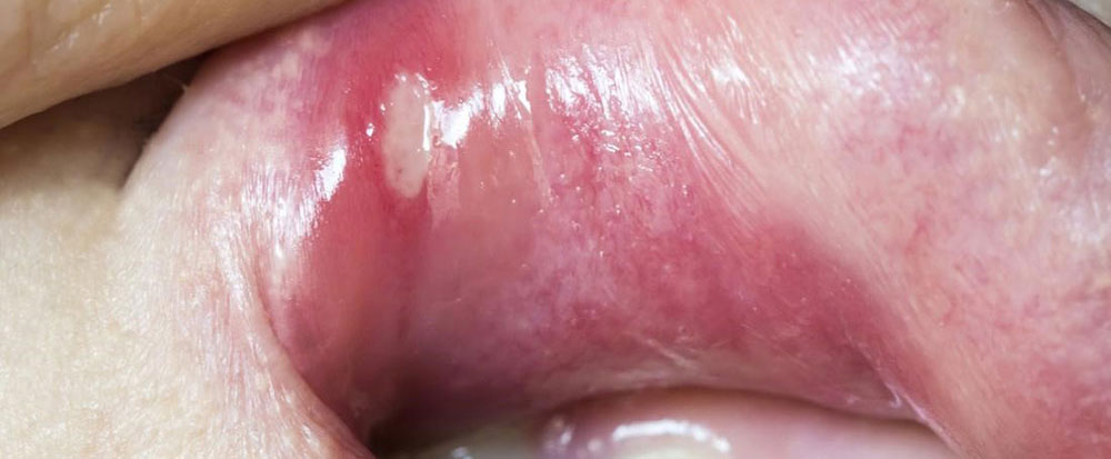 aphthous ulcer in the mouth