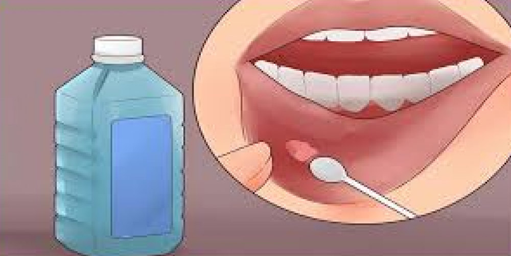 orale medizin die auf den mund gerieben wird