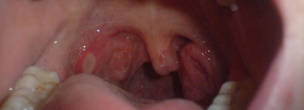 aphthous ulcer sign in the mouth