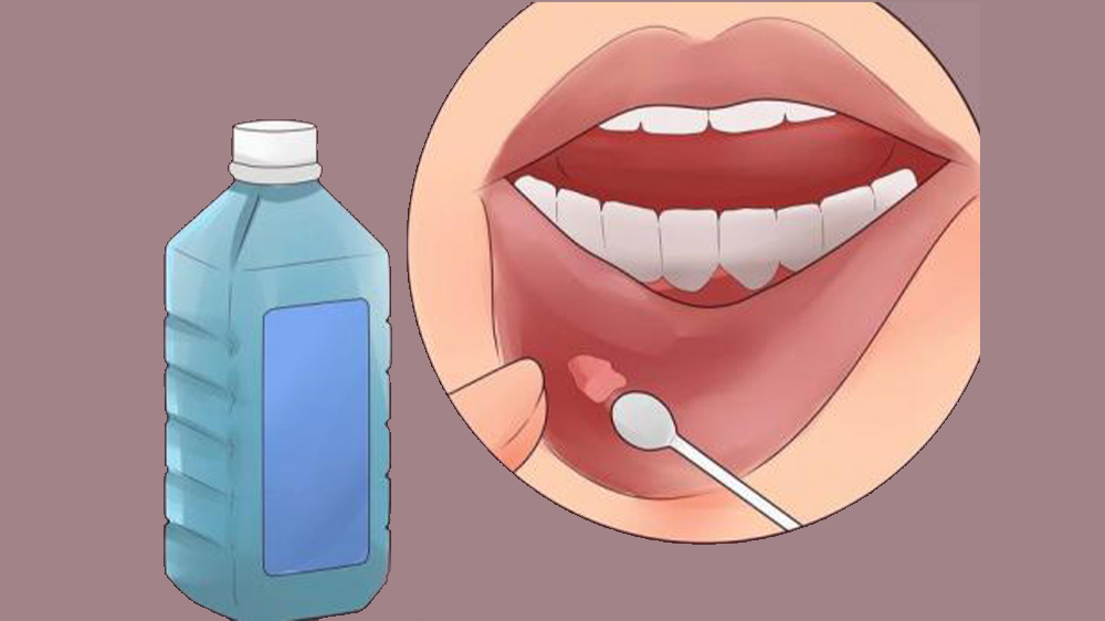 دواء قرحة الفم الذي يفرك على الفم