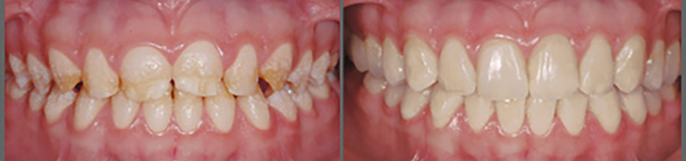 قبل و بعد درمان رنگ و شکل دندان با کامپوزیت