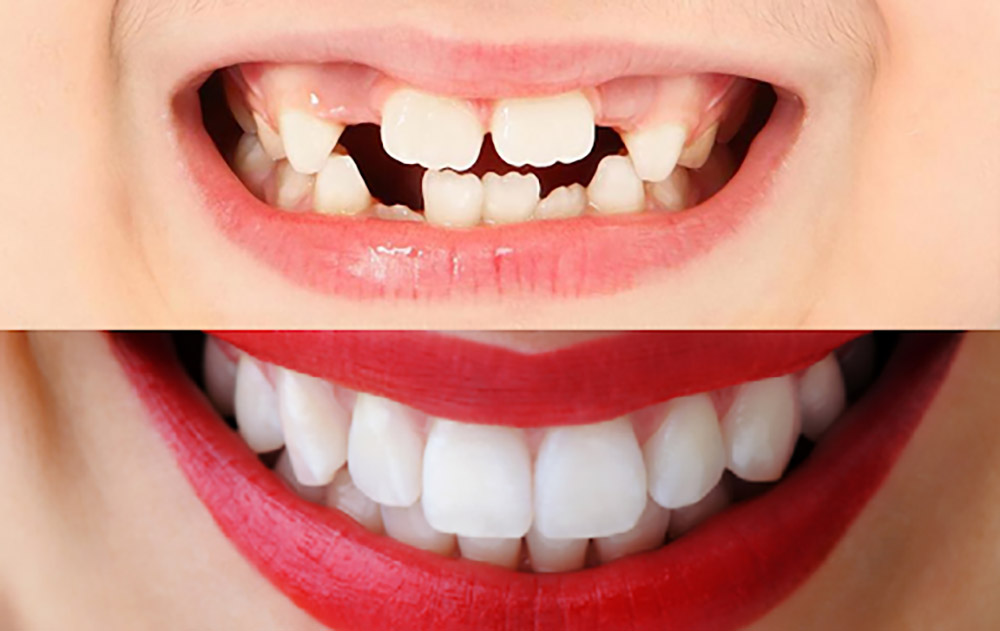 قبل و بعد درمان ارتودنسی و کامپوزیت دندان