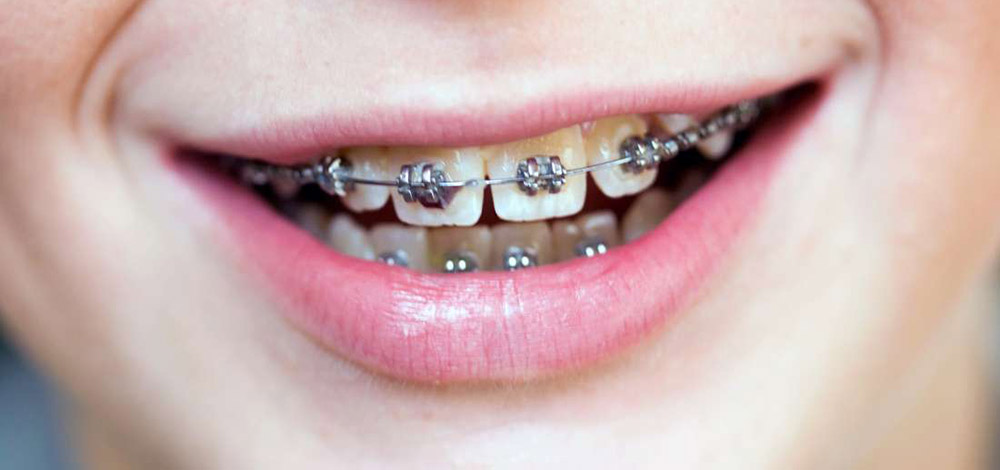 درمان فاصله بین دندان ها با ارتودنسی