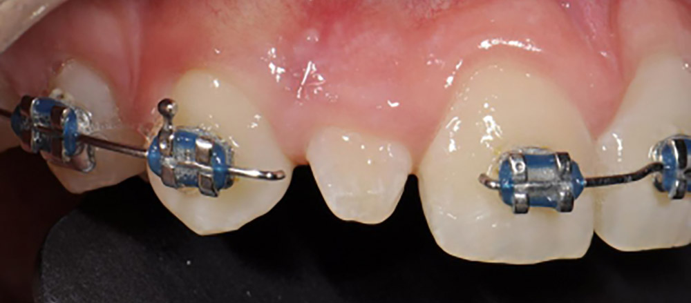 ارتودنسی دندان و یک دندان که نیازمند ونیر است