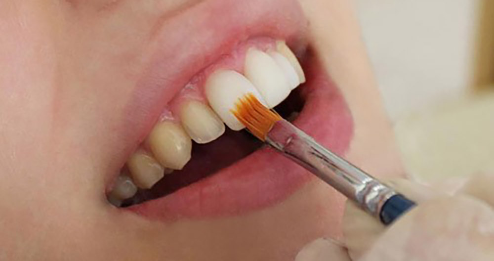 سفید کردن دندان با استفاده از ونیر