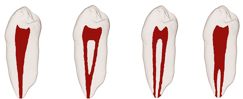 شماتیک چهار نوع از انواع ریشه دندان
