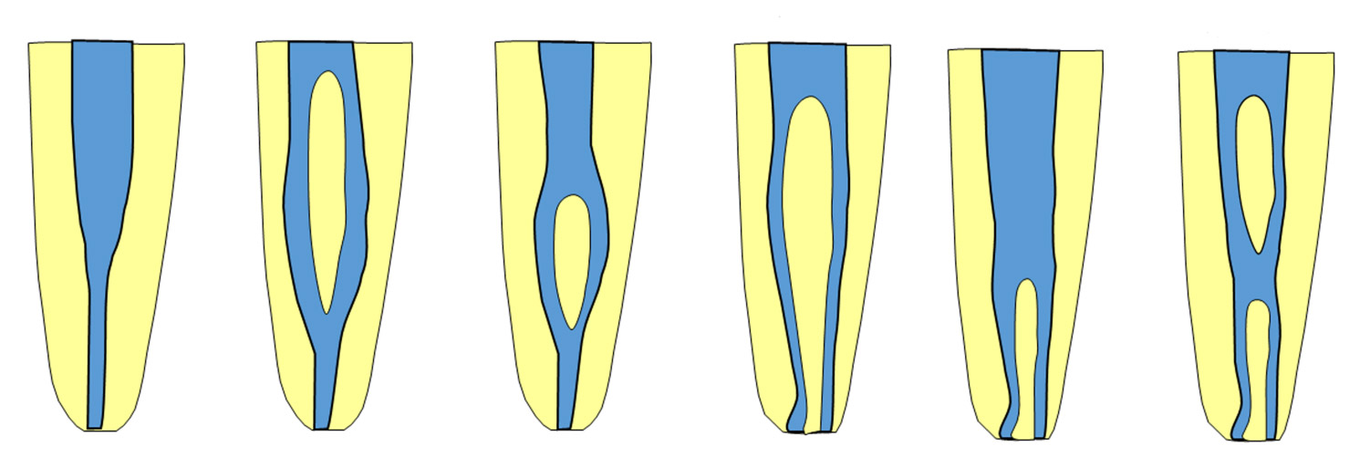شماتیک شش نوع از انواع ریشه دندان