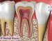 انواع ریشه دندان