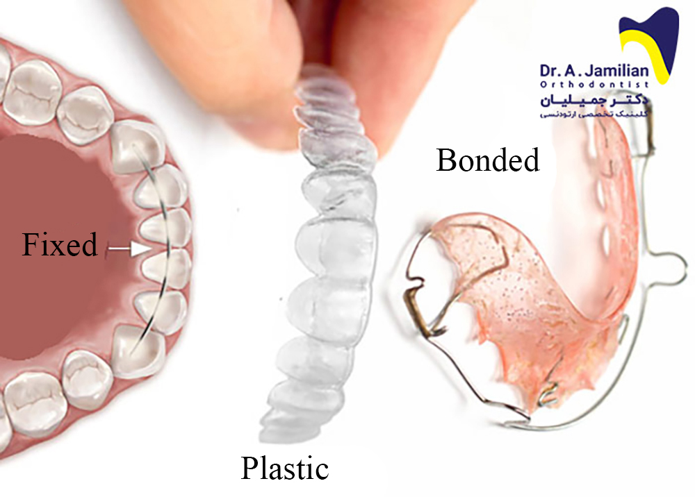 أنواع المثبتات بعد علاج تقويم الأسنان