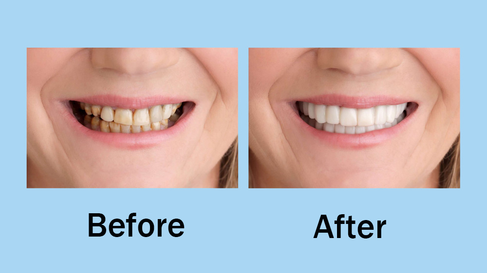 before and after using removable dental veneer