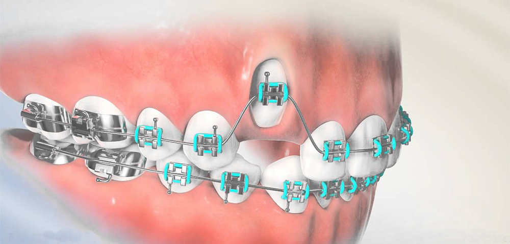 درمان ارتودنسی دندان نهفته