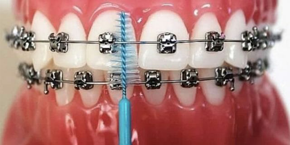 فرشاة أسنان بين الأسنان توضع على نموذج لأسنان بشرية مع جهاز تقويم أسنان ثابت