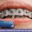 شخص ينظف الأسنان الخاضعة للعلاج التقويمي بفرشاة ما بين الأسنان