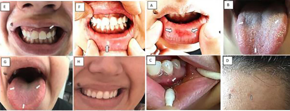 eight examples of corona symptoms on the lips, tongue and forehead