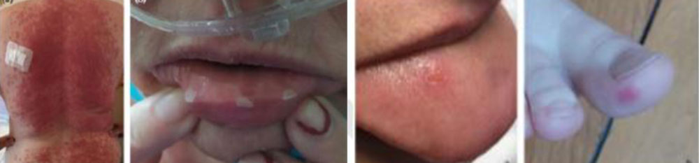 hornhauthautsymptome an rücken, lippen, zunge und großem zeh