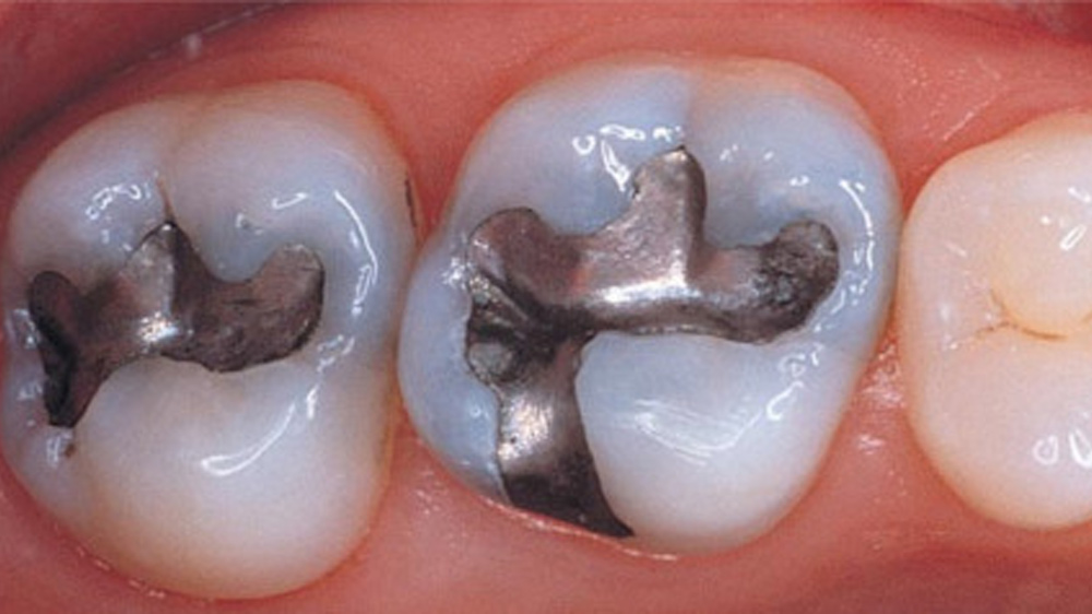 zwei mit Amalgam gefüllte Zähne
