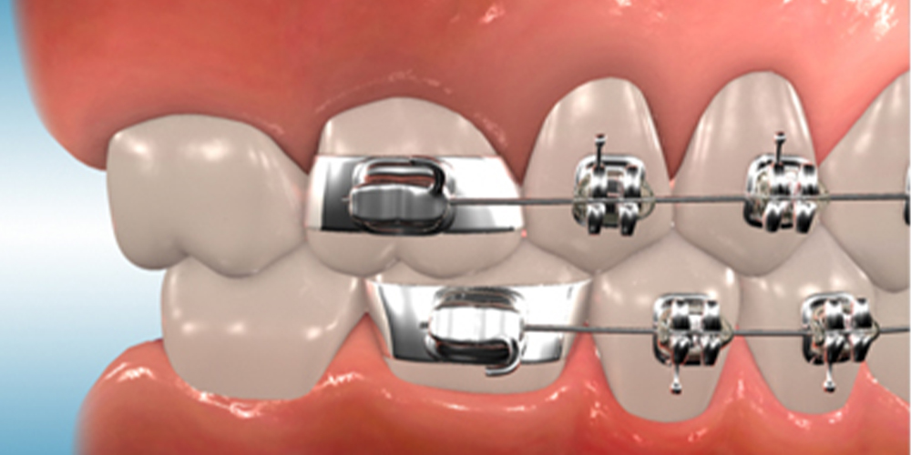 orthodontics of upper and lower teeth with orthodontic bands