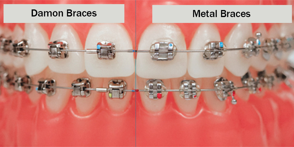 مقارنة بين قوس تقويم الأسنان من دامون و قوس تقويم الأسنان المعدنی