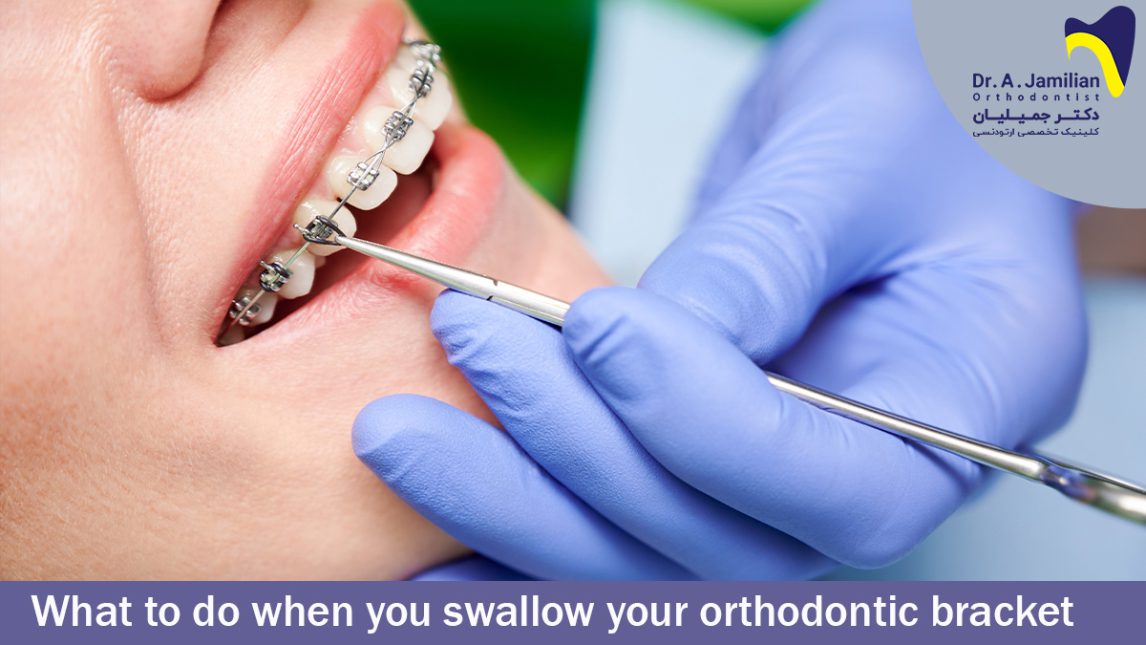 What to do when you swallow your orthodontic bracket? Dr Jamilian