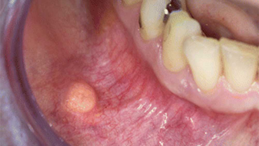 لیپوما در دهان یک بیمار