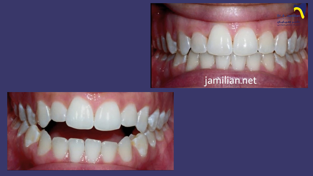 before and after of orthodontic treatment for open bite by dr jamilian