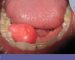 لیپوما یا غده چربی که در زیر زبان پشت دندان های فک پایین ایجاد شده است