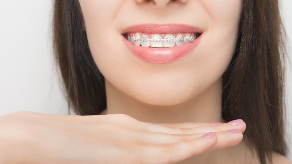 young woman smile with dental brackets
