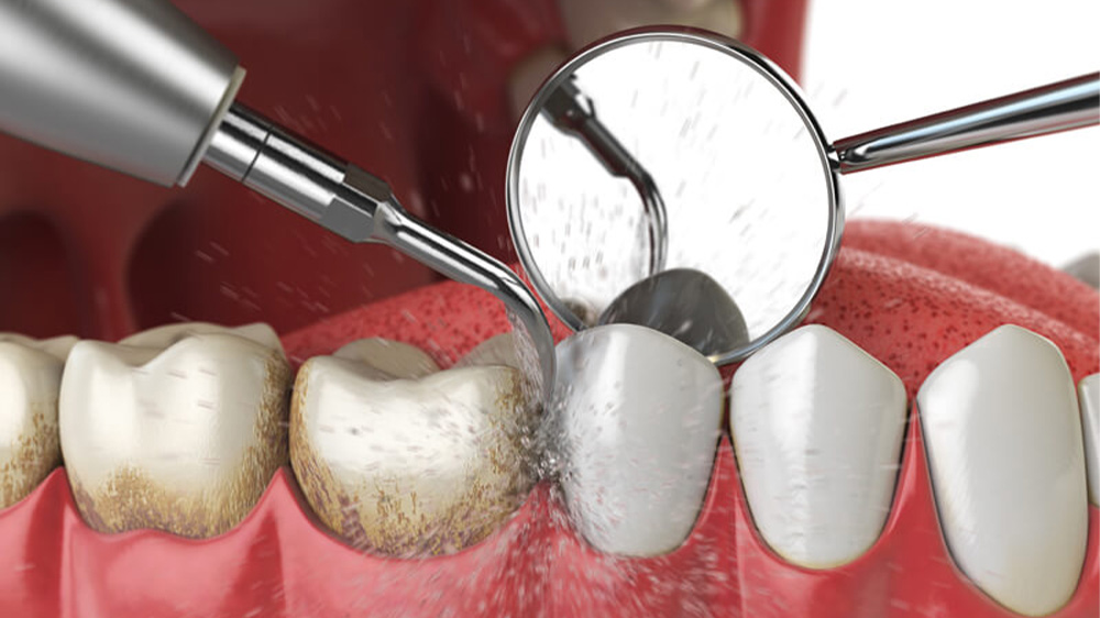 جرم گیری دندان با ابزار جرم گیری و آینه کوچک توسط دندانپزشک