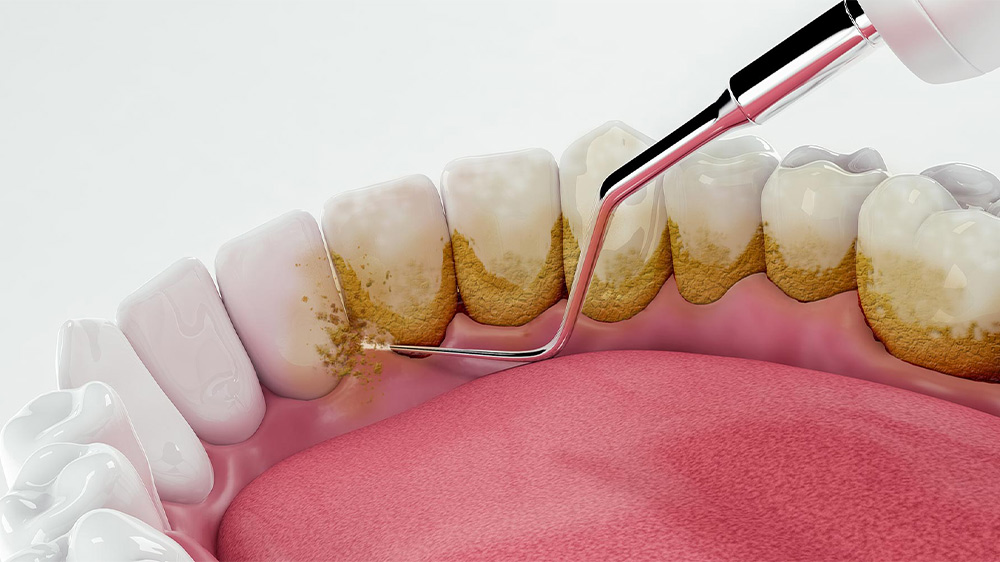 جرم گیری پشت دندان ها توسط دندانپزشک