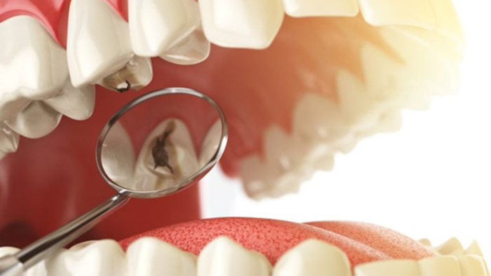 tooth decay under the dental veneers