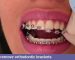 remove orthodontic brackets