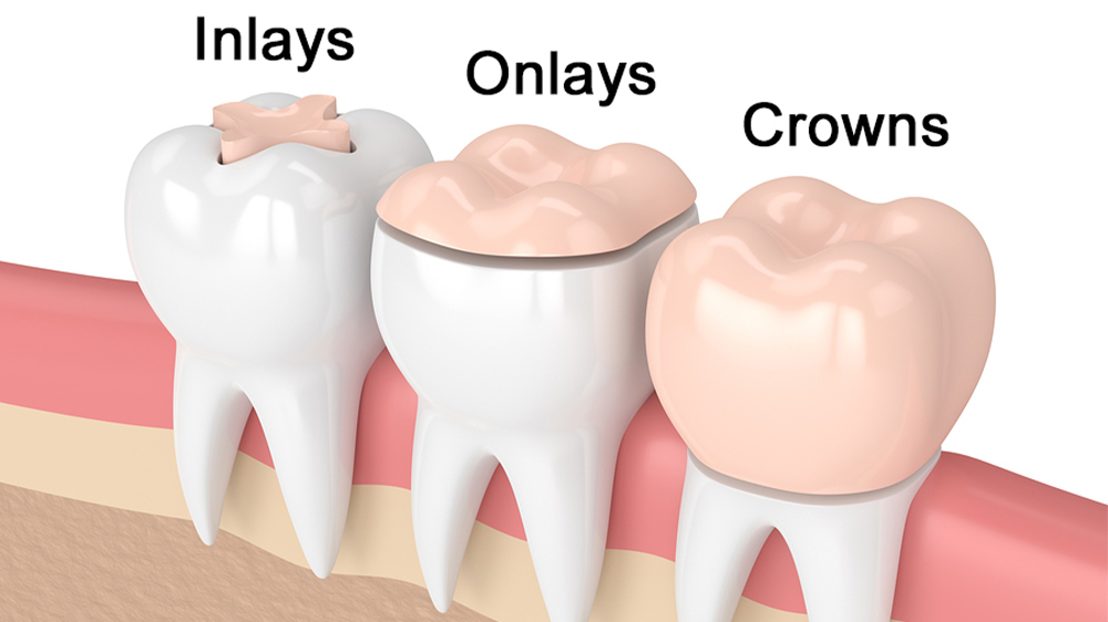 inlay, onlay and crown placements on tooth