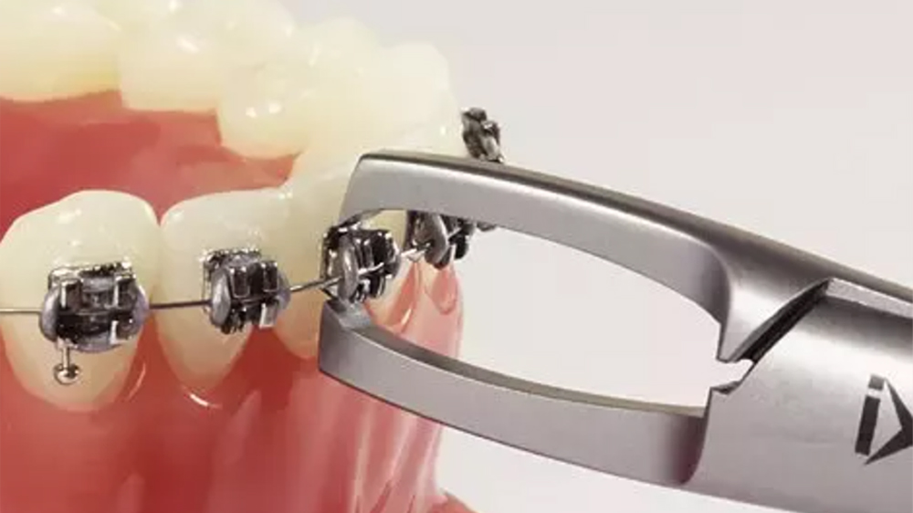 برداشتن کردن براکت ارتودنسی با استفاده از انبر مخصوص از روی دندان