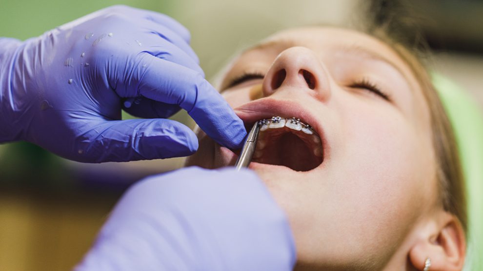 How To Remove Orthodontic Brackets? Dr Jamilian