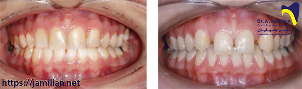 closing the diastema with quick orthodontic