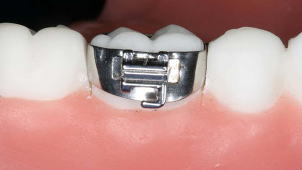 orthodontic band