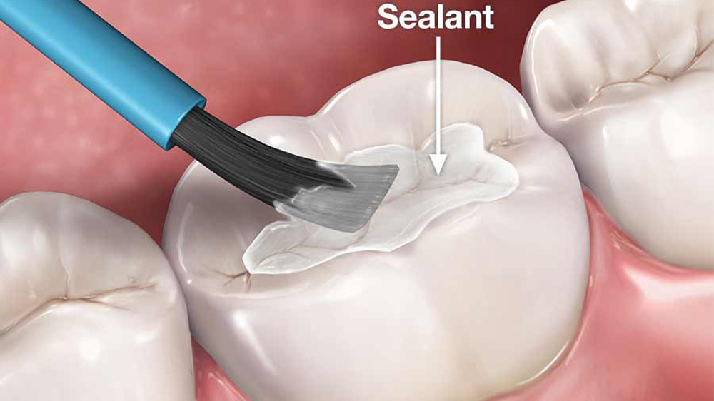 a tooth with sealant